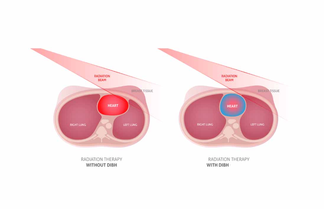 Deep Inspiratory Breath Hold (DIBH) is a game changing modern technique in Breast Cancer Radiotherapy